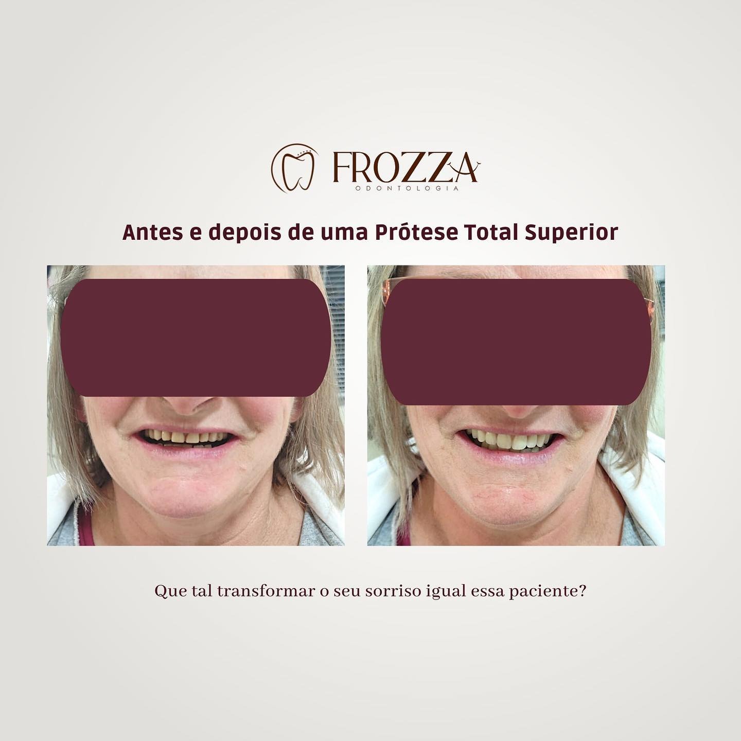Antes e depois de prótese total superior em paciente mulher