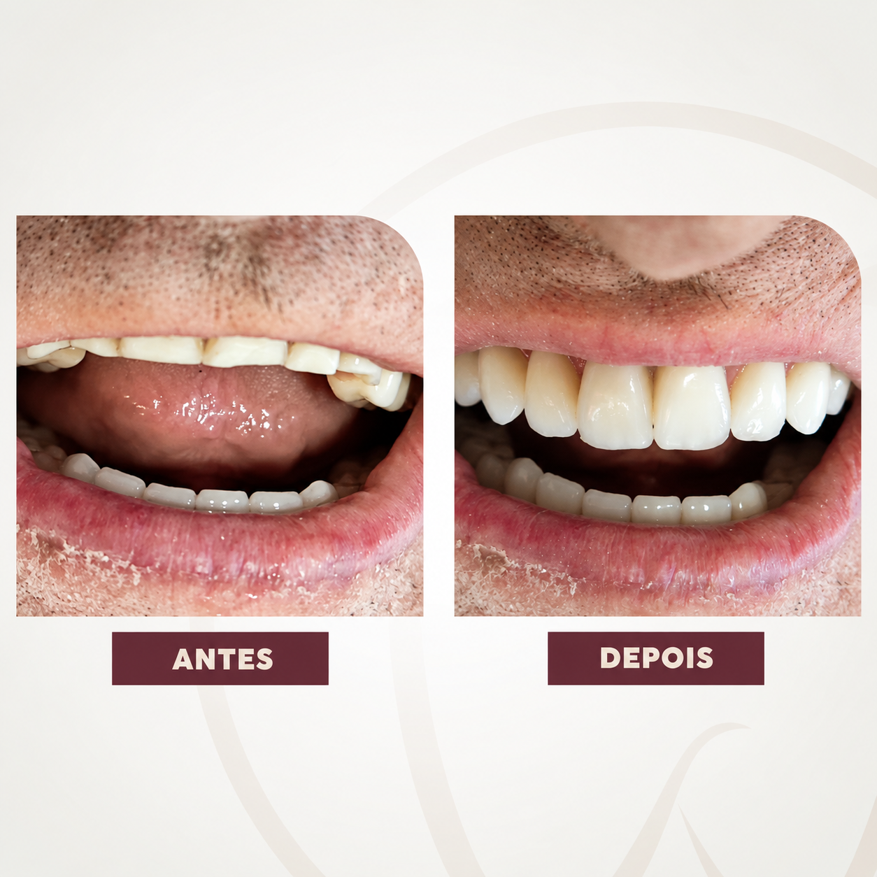 Antes e depois de prótese dentária superior em paciente homem
