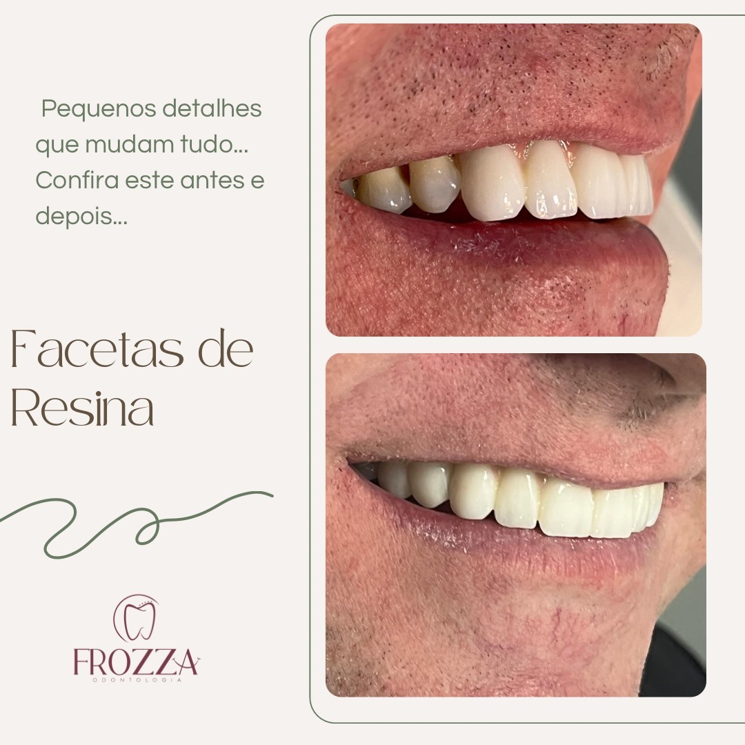 Antes e depois de facetas de resina em paciente homem