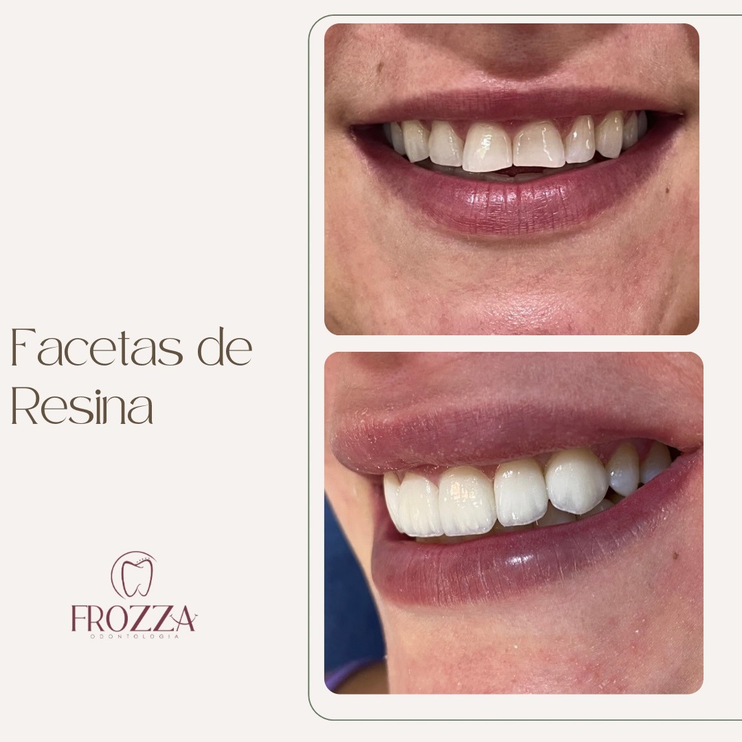 Antes e depois de facetas de resina em paciente mulher