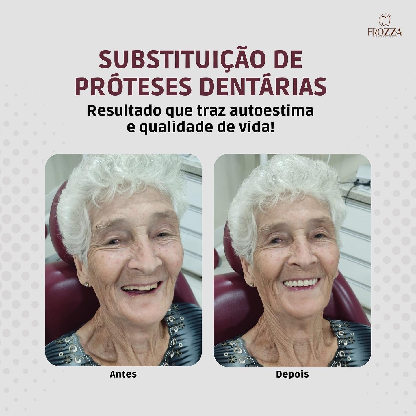 Antes e depois da substituição de próteses dentárias em paciente idosa