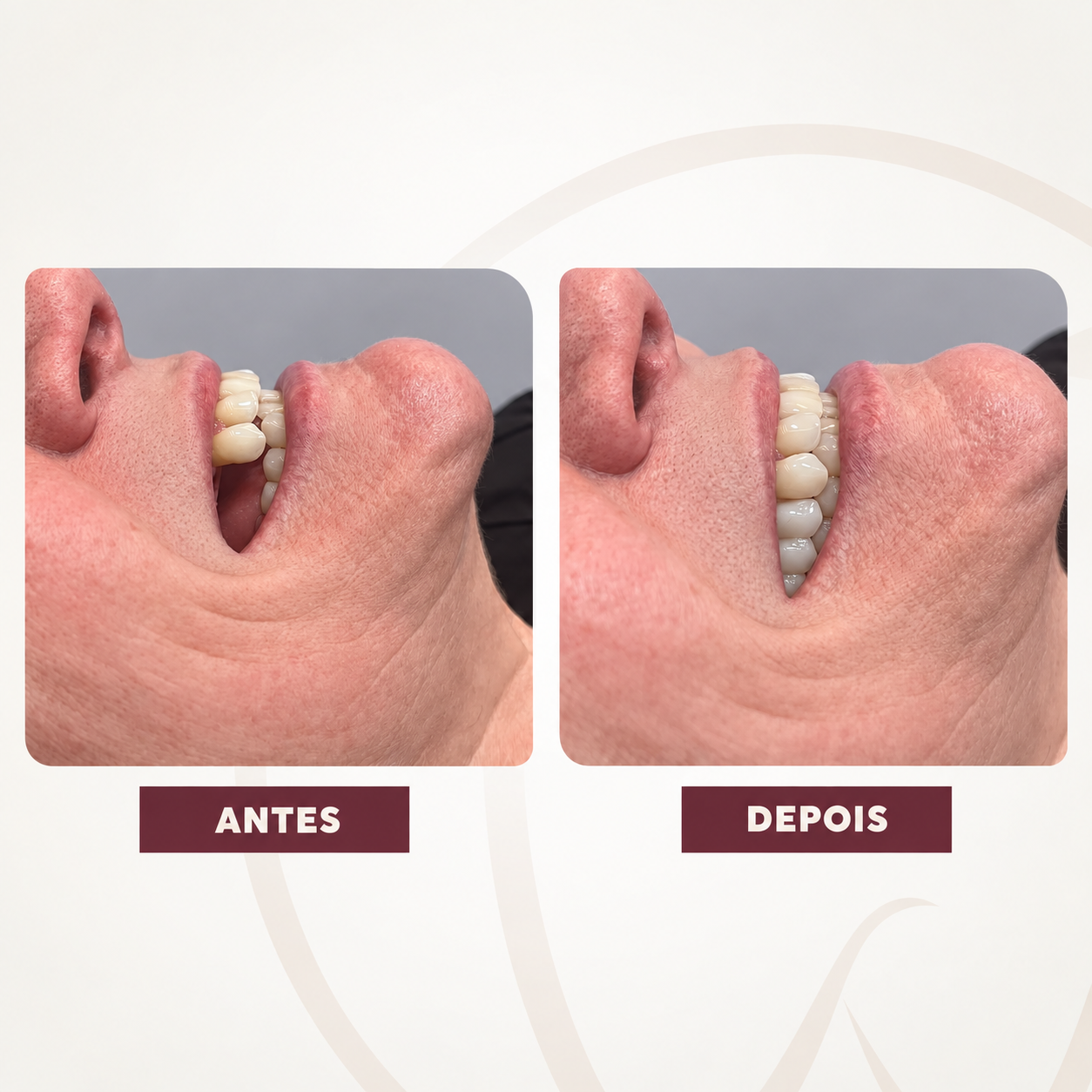 Antes e depois de prótese dentária inferior em paciente homem
